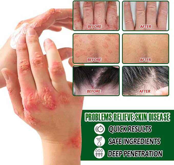 Psoriasis Cream - Herbal Plant Extracts