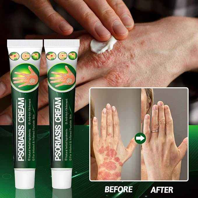 Psoriasis Cream - Herbal Plant Extracts