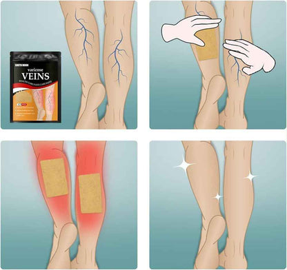 South Moon Varicose Veins Health Care Patch | 12 Pcs | Improve Circulation & Relieve Swelling