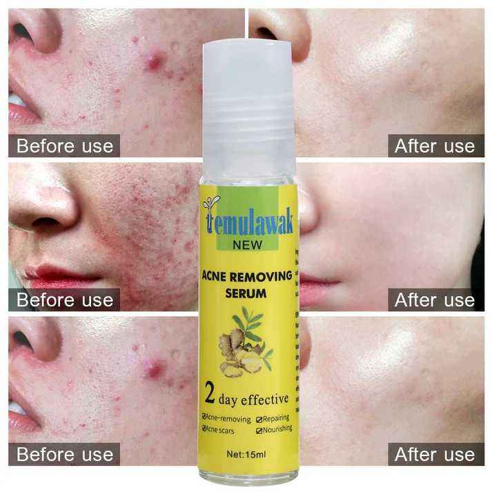 Temulawak - New Acne Removing Serum (Original)